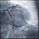 Tu Tập & Chữa Trị Heart Attack
